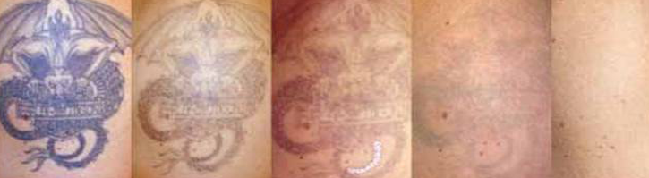 Tattoo Entfernung Volketswil